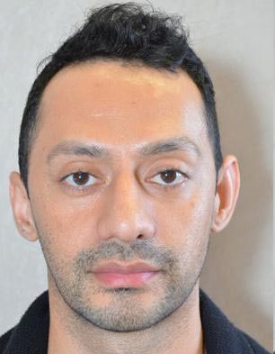 otoplastie avant apres