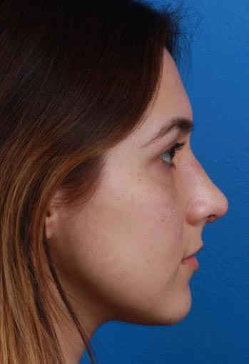 rhinoplastie avant apres