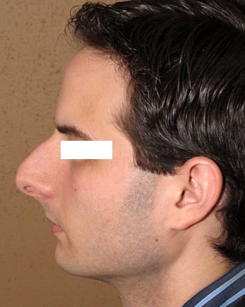 rhinoplastie avant apres