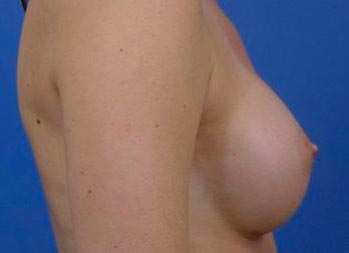 augmentation mammaire avant apres