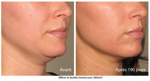 mincir-menton-centre-ultherapy-paris2-300x162
