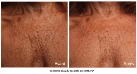 ultherapy décolleté femme rousse avant après - CSHP Paris