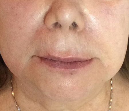 injections acide hyaluronique rides après